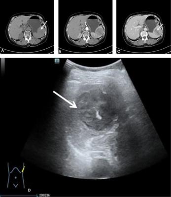 Imaging and pathological comparison of inflammatory pseudotumor-like follicular dendritic cell sarcoma of the spleen: A case report and literature review